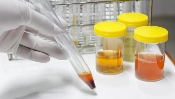 Urine Anda Bisa Tunjukkan Gejala Kanker Ginjal!